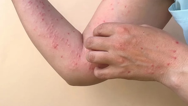 Okulların ara tatile girmesinin ardından ikinci dönemin başlamasıyla aynı sınıfta yeni hastaların görülmesi üzerine, 9/H sınıfında öğretim yılının sonuna kadar eğitime ara verildi. Görseli
