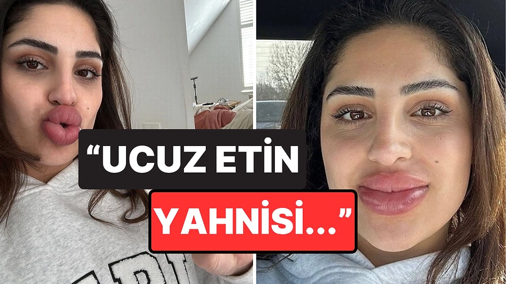 Dudak Dolgusu Yaptırayım Derken Hayatının Pişmanlığını Yaşayan Kadından İlginç Açıklamalar