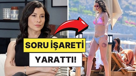 Deniz Sezonunu Açan Müjde Uzman'ın Bacağındaki Büyük Morluk Merak Uyandırdı!