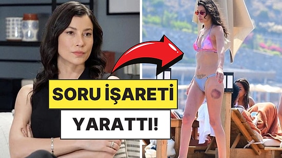 Deniz Sezonunu Açan Müjde Uzman'ın Bacağındaki Büyük Morluk Merak Uyandırdı!