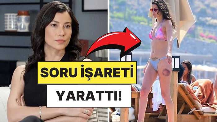 Deniz Sezonunu Açan Müjde Uzman'ın Bacağındaki Büyük Morluk Merak Uyandırdı!