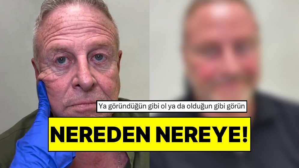 Bambaşka Birine Dönüştü: Tüm Yüzüne Estetik Yaptıran Adam 20 Yaş Gençleşti
