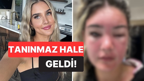 Sadece Güneşlenmek İstemişti: Güneş Kremi Sürmeyi Unuttuğu İçin Tatili Adeta Cehenneme Döndü!