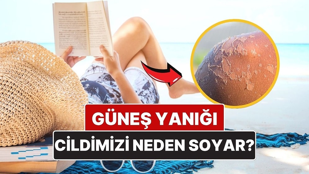 Güneş Yanığından Sonra Cildimiz Neden Soyulur?