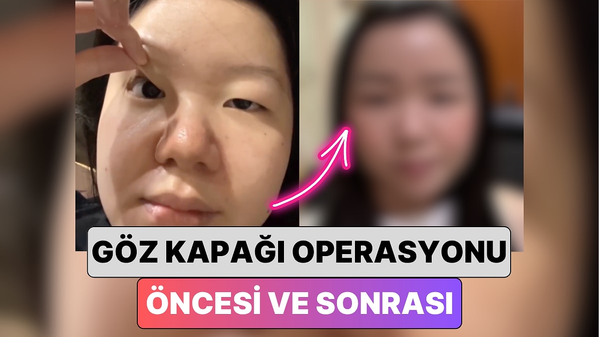 Güney Kore&apos;de Bir Kadın En Yaygın Estetiklerden Biri Olan Göz Kapağı Operasyonu ile Yaşadığı Değişimi Paylaştı