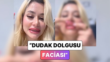 Dolgu Kaydı: Dudak Dolgusu Yaptıran Bir Kadın Dudaklarının Geldiği Son Hali Paylaştı