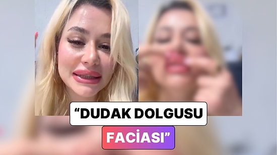 Dolgu Kaydı: Dudak Dolgusu Yaptıran Bir Kadın Dudaklarının Geldiği Son Hali Paylaştı