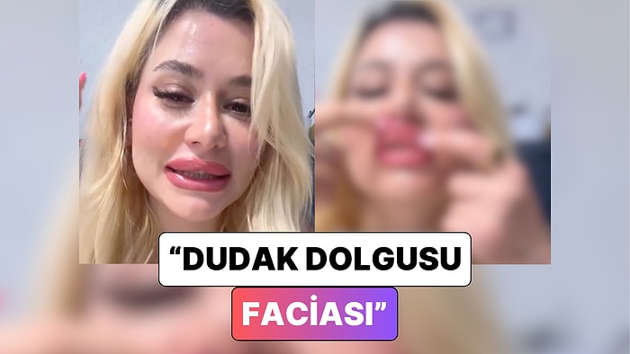 Dolgu Kaydı: Dudak Dolgusu Yaptıran Bir Kadın Dudaklarının Geldiği Son Hali Paylaştı