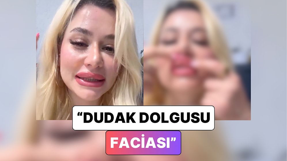 Dolgu Kaydı: Dudak Dolgusu Yaptıran Bir Kadın Dudaklarının Geldiği Son Hali Paylaştı