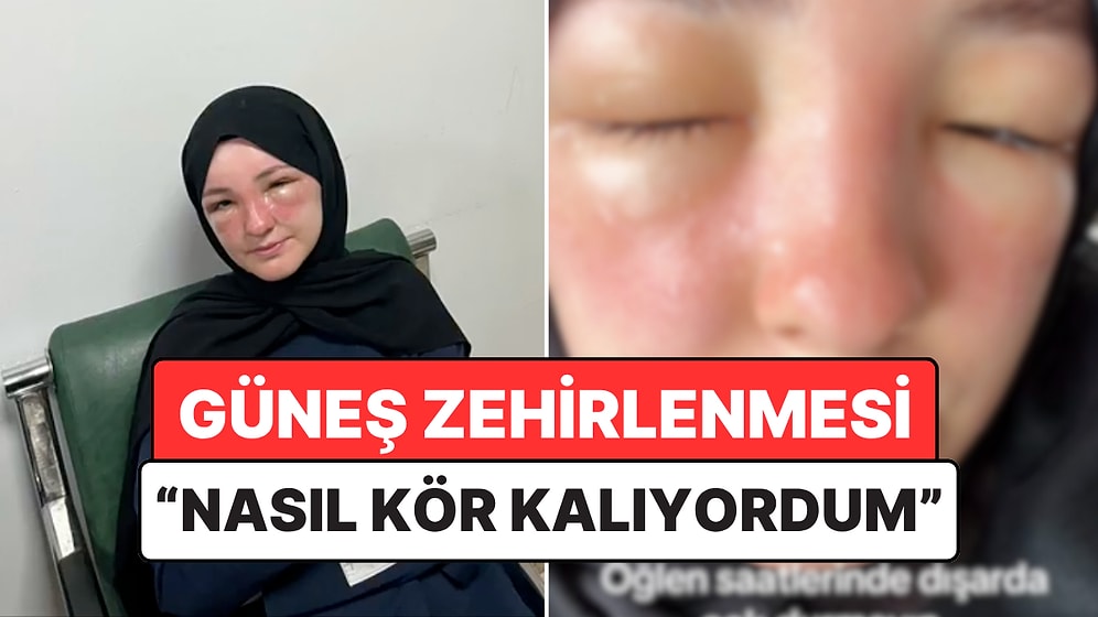 "Güneş Zehirlenmesi" Yaşayan Genç Yüzündeki Korkutucu Değişimi Paylaştı