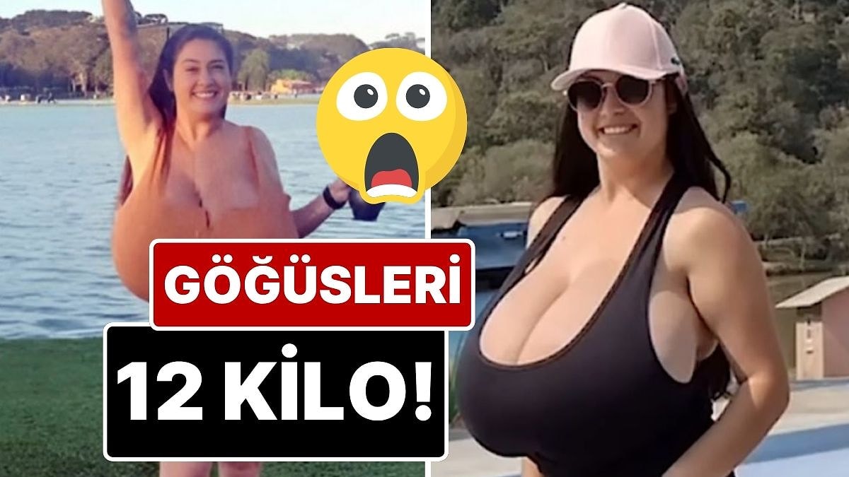 Brezilyalı Kadının ‘Büyük Göğüs’ Hastalığı: Aşırı Büyüyen Göğüsleri 12 Kilo Oldu!