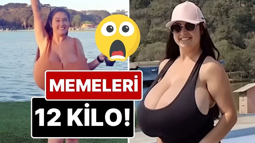 Brezilyalı Kadının ‘Büyük Meme’ Hastalığı: Aşırı Büyüyen Memeleri 12 Kilo Oldu!