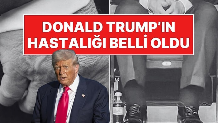 Donald Trump'ın Hastalığı Açıklandı: Kronik Venöz Yetmezlik