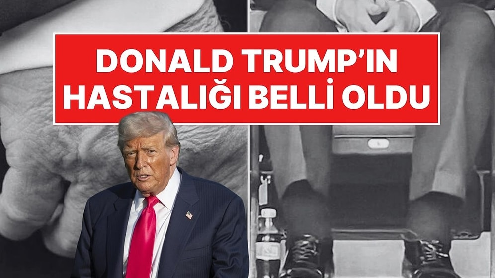 Donald Trump'ın Hastalığı Açıklandı: Kronik Venöz Yetmezlik