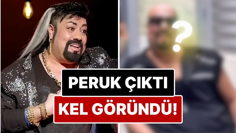Peruk Düştü Kel Göründü: Protez Saçı Yüzünden Enfeksiyon Kapan Kobra Murat'ın Saçsız Hali Ortaya Çıktı!
