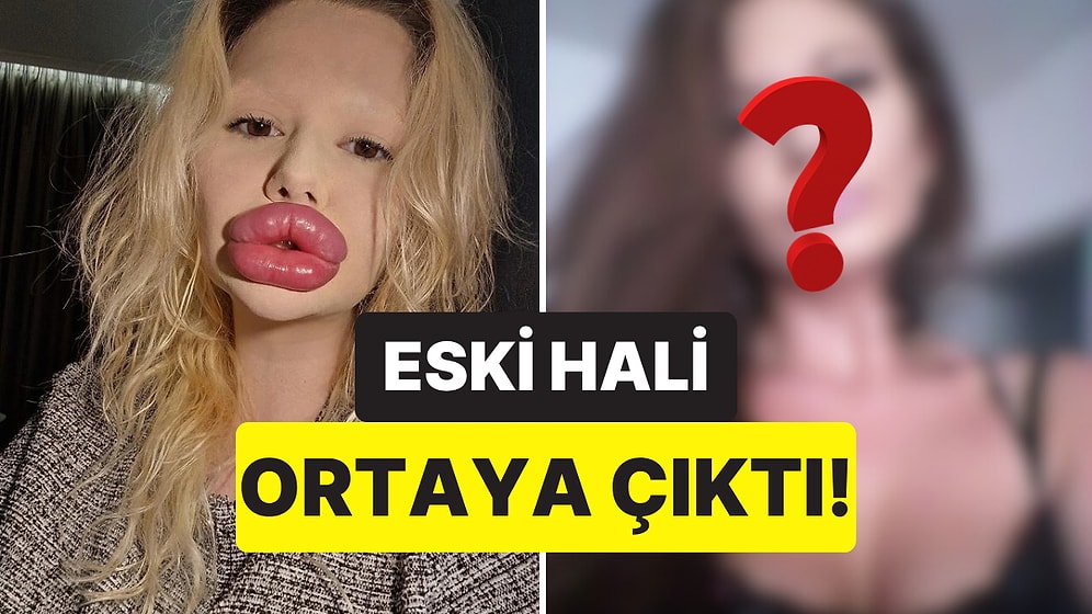 "Dünyanın En Büyük Dudaklı Kadını" Olarak Biliniyordu: Estetik Geçirmeden Önceki Hali Şaşırttı!