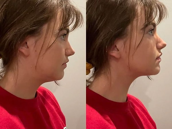 Jawline/Çene Dolgusu