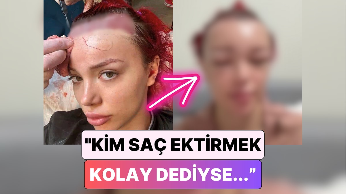 Biz Saç Ekimi Ülkesiyiz: Saç Ektirme İşlemi Yaptıran Bir Kadın Yüzünün Geldiği Hali Paylaştı