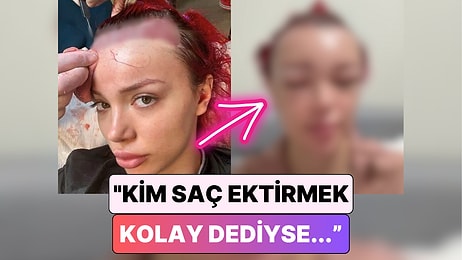 Biz Saç Ekimi Ülkesiyiz: Saç Ektirme İşlemi Yaptıran Bir Kadın Yüzünün Geldiği Hali Paylaştı