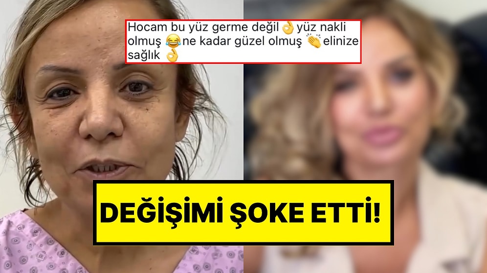 Tüm Yüzüne Estetik Yaptıran Bir Kadının Yaşadığı Değişim Karşısında Hayretler İçerisinde Kalacaksınız