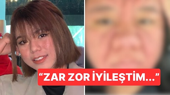 Doğum Sonrası Yüzünde Ürkütücü Şeyler Çıkmaya Başlayan Kadın Yaşadığı Süreci Anlattı