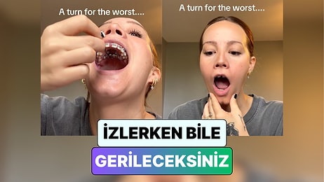 İzlerken Gerileceksiniz! Bir Kadın Diş Telini Ayarlamaya Çalışırken Çenesi Kilitlendi