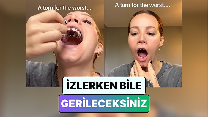 İzlerken Gerileceksiniz! Bir Kadın Diş Telini Ayarlamaya Çalışırken Çenesi Kilitlendi