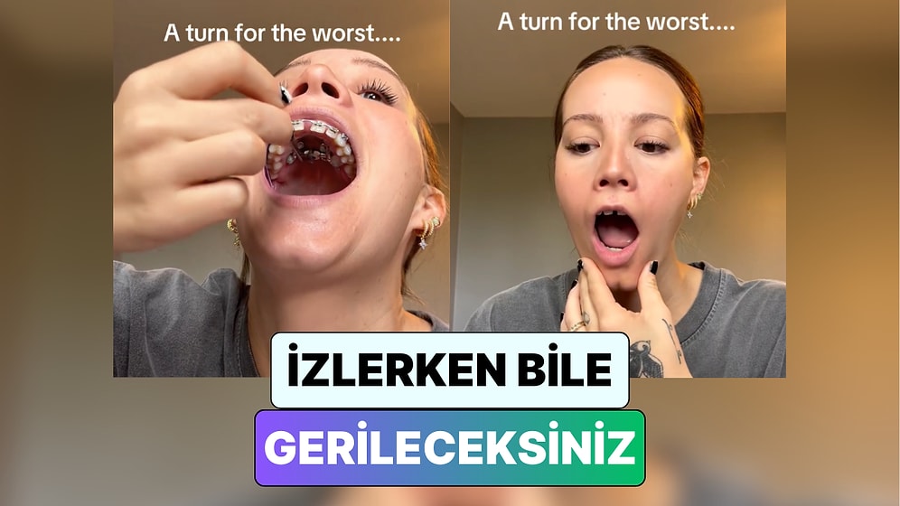 İzlerken Gerileceksiniz! Bir Kadın Diş Telini Ayarlamaya Çalışırken Çenesi Kilitlendi