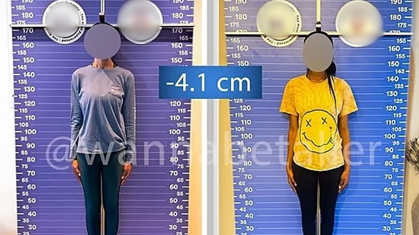 Uzun boylu kadınlar boyunu kısaltmak amacıyla son derece acılı bir ameliyat geçirmek için Türkiye’ye geliyor.