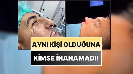Aynı Kişi Olduğuna Kimse İnanamadı: Genç Hasta, Burun Estetiğiyle Bambaşka Biri Oldu!