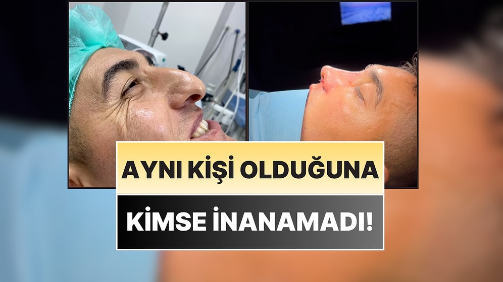 Aynı Kişi Olduğuna Kimse İnanamadı: Genç Hasta, Burun Estetiğiyle Bambaşka Biri Oldu!