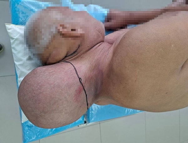 Rusya’nın Kirov şehrinde yaşayan 65 yaşındaki bir adam, 16 yıl boyunca boynunda neredeyse kendi başı büyüklüğünde bir dev tümörle yaşadı ve sonunda ameliyatla alınabildi.