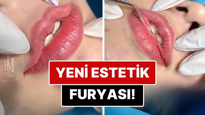 Yeni Estetik Trendi mi Doğuyor? "Kalp Dudak" Estetiği İçin Uygulanan Operasyon İçinizi Bi' Tuhaf Yapacak!