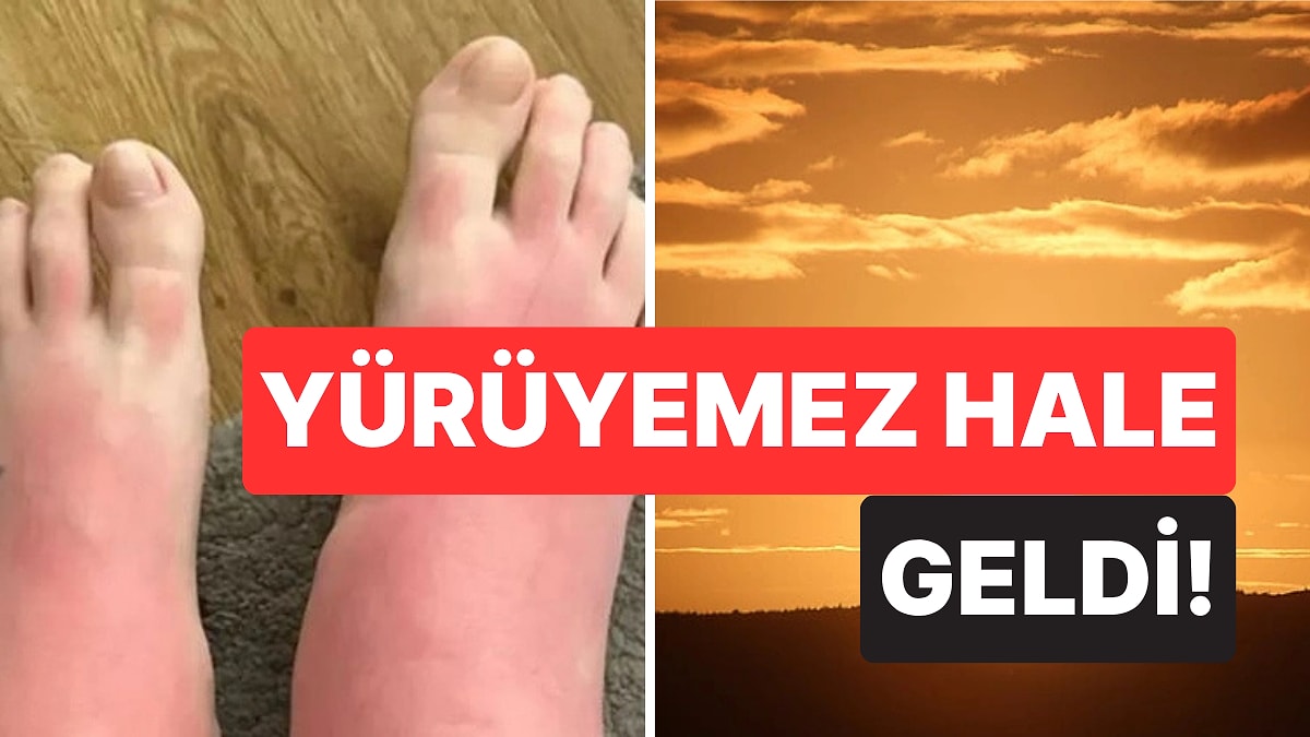 Zehirlendi! &quot;Yaz Tatilinin Şanındandır&quot; Diyerek Saatlerce Güneşlenen Turist Hayatının Kabusunu Yaşadı