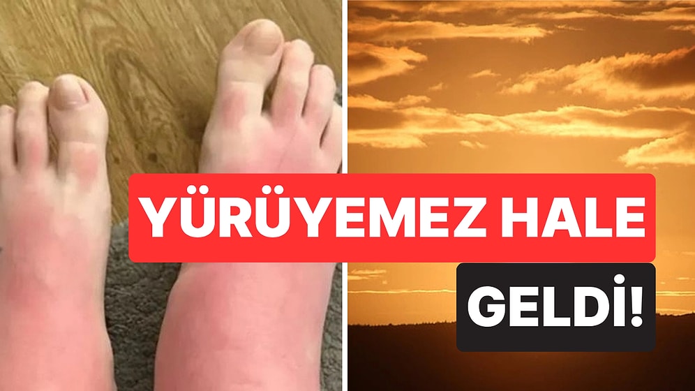 Zehirlendi! "Yaz Tatilinin Şanındandır" Diyerek Saatlerce Güneşlenen Turist Hayatının Kabusunu Yaşadı