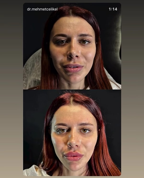 Doktorun yaptığı paylaşımda dudak dolgusu yaptırdığı ortaya çıkan Survivor Nefise'nin estetikli hali kısa sürede viral oldu.
