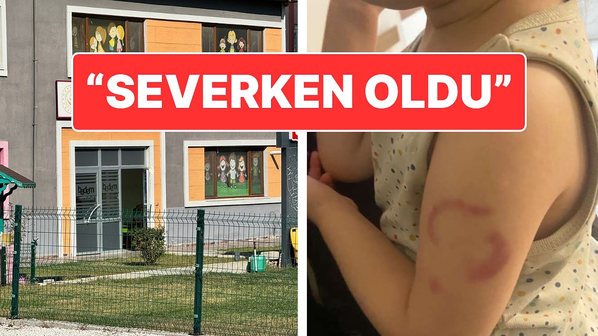 Koldaki Isırık İzine Öğretmenden İlginç Savunma: &quot;Isırmadım Öperken Oldu&quot;