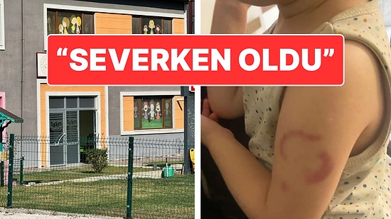 Koldaki Isırık İzine Öğretmenden İlginç Savunma: "Isırmadım Öperken Oldu"