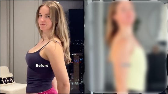 Woman Shares Her Transformation After Removing Breast Implants Years Later