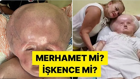 3 Ay Yaşaması Beklenen Oğluna 31 Yaşına Kadar Bakan Brezilyalı Anne Tartışma Yarattı