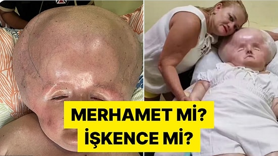 3 Ay Yaşaması Beklenen Oğluna 31 Yaşına Kadar Bakan Brezilyalı Anne Tartışma Yarattı