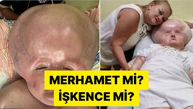 3 Ay Yaşaması Beklenen Oğluna 31 Yaşına Kadar Bakan Brezilyalı Anne Tartışma Yarattı