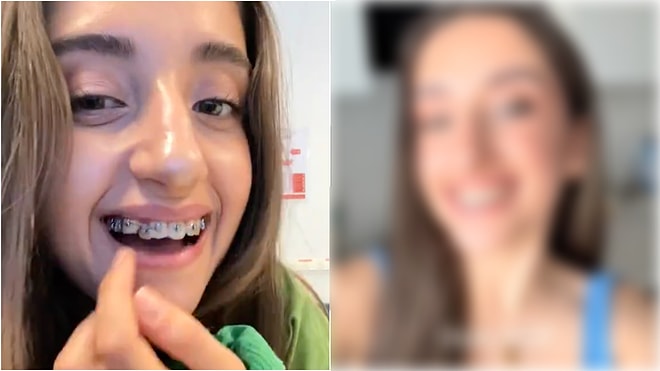 A Woman with Braces Shares How Her Teeth Came in After 14 Months