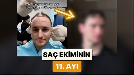 Bambaşka Biri Olmuş: Saç Ektiren İçerik Üreticisi Zeph Sanders 11 Ayda Saçlarının Geldiği Hali Paylaştı