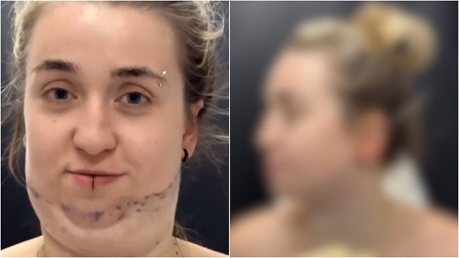 The Woman Who Transformed into a Completely Different Person After the Double Chin Surgery