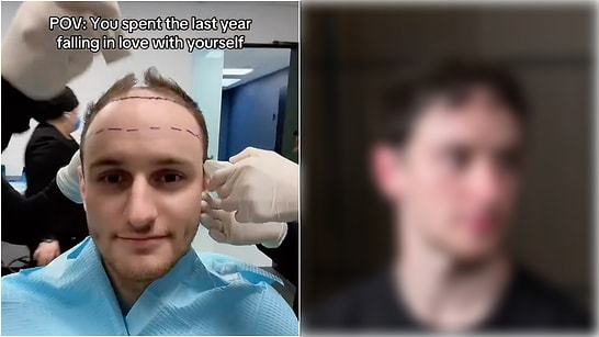 Content Creator Zeph Sanders Had a Hair Transplant and Shared Transformation in 11 Months