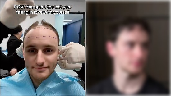 Content Creator Zeph Sanders Had a Hair Transplant and Shared Transformation in 11 Months