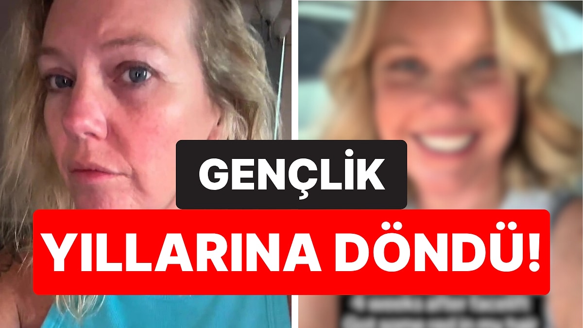 Yüz Gerdirme Yaptırdıktan Sonra Gençlik Yıllarına Dönen 45 Yaşındaki Kadının Son Hali Şaşırttı