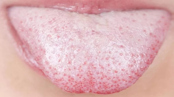 Aynadaki Tehlike: Dildeki Tuhaf Beyaz Tabaka ve Ağız Kokusu