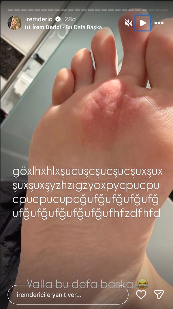 Refuting breakup rumors with the statement, "This relationship won't end because it's unclear who's crazier," İrem Derici also shared the current state of her foot.